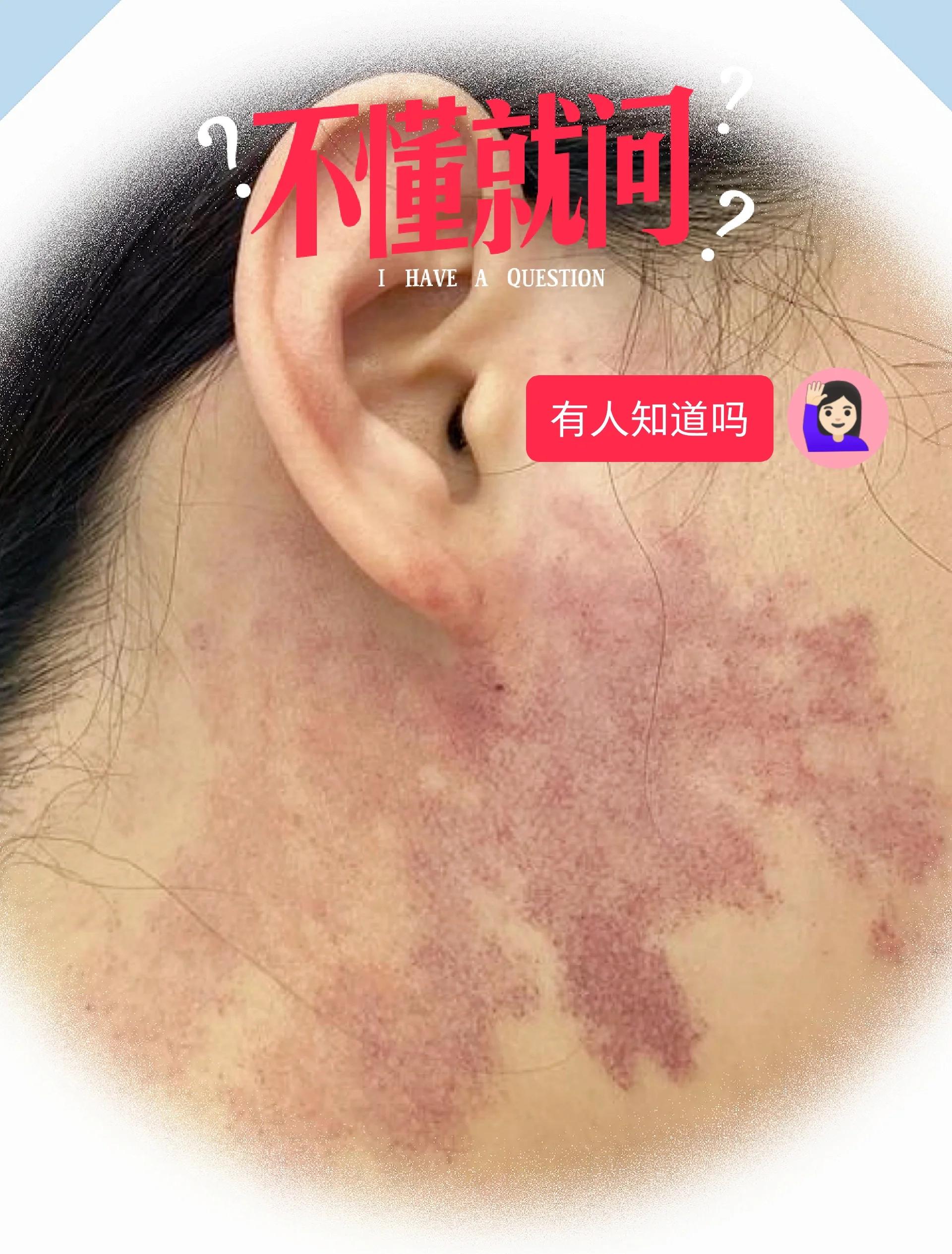 20种很好很有福气的胎记胎记长在眉头和屁股下面很好很有福气