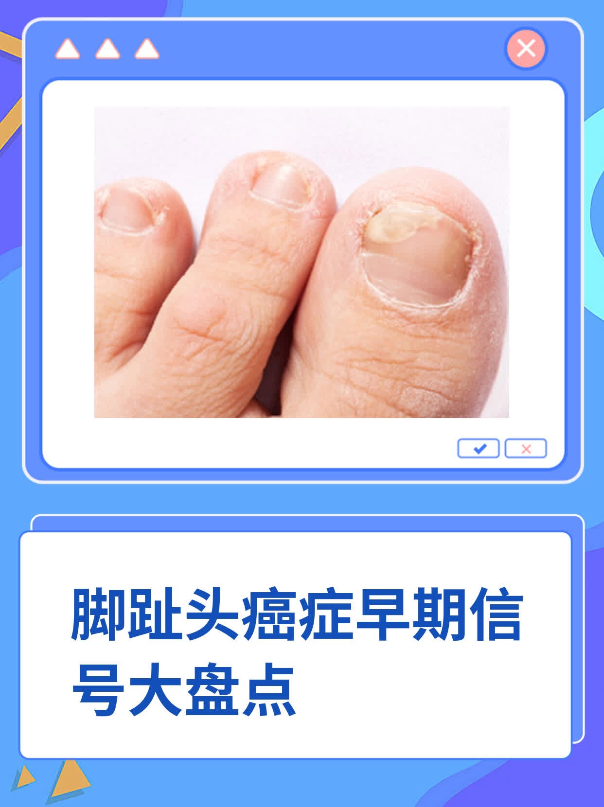 脚趾头长痣代表什么预兆