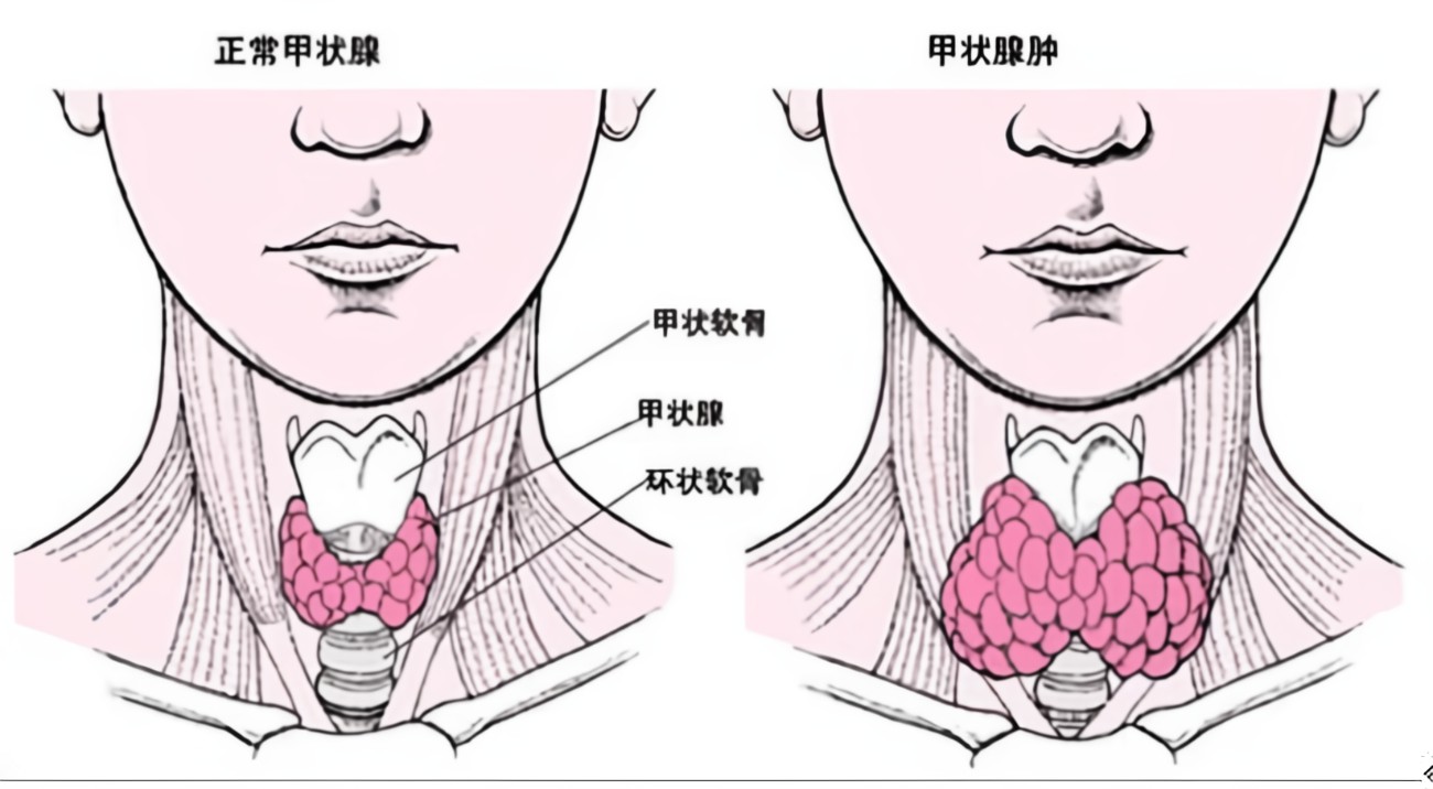 女人甲状腺在哪个部位图片