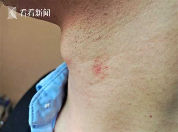梦见吻痕是什么意思呀