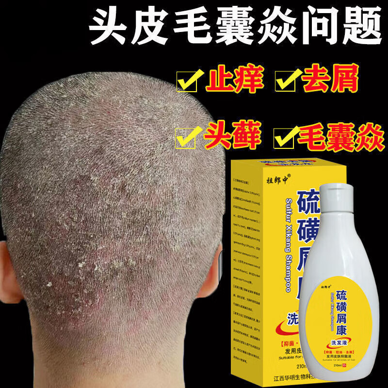 硫磺皂洗头发有什么用