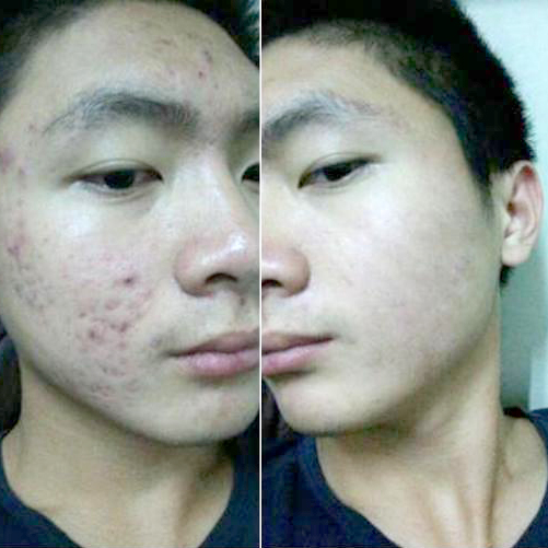 脸上长痘痘的搞笑句子发个朋友圈