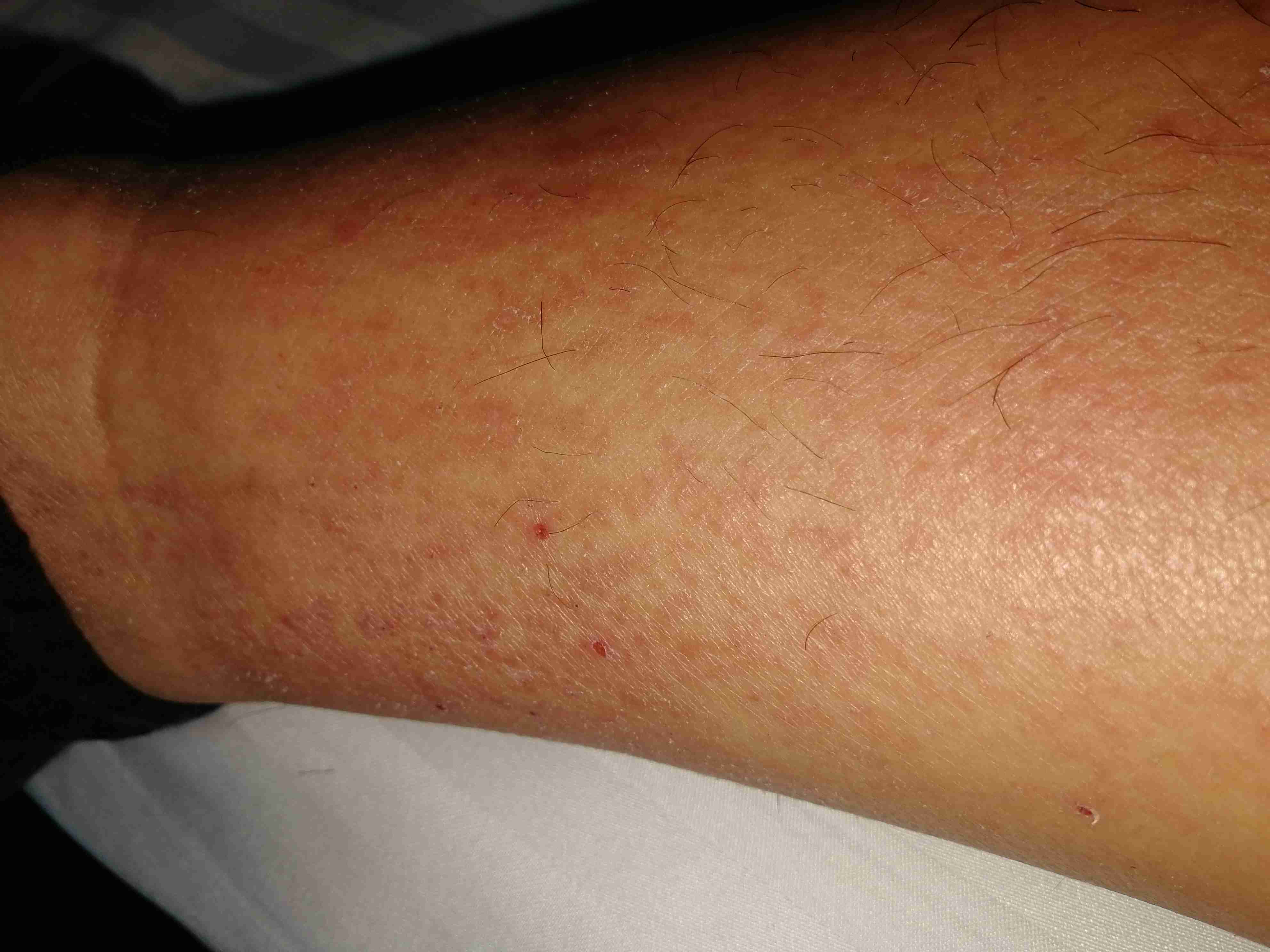 腿上很痒一抓就破皮出血