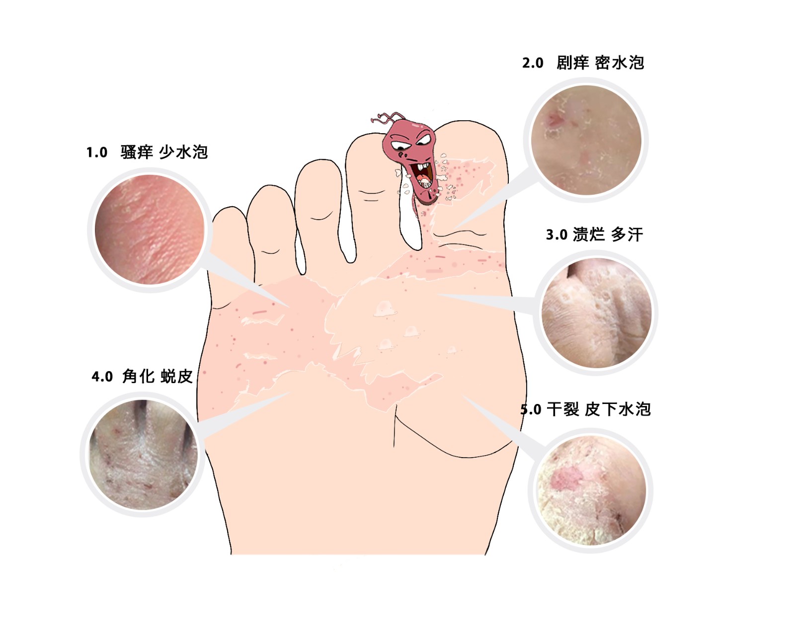 如何治脚气有效的方法