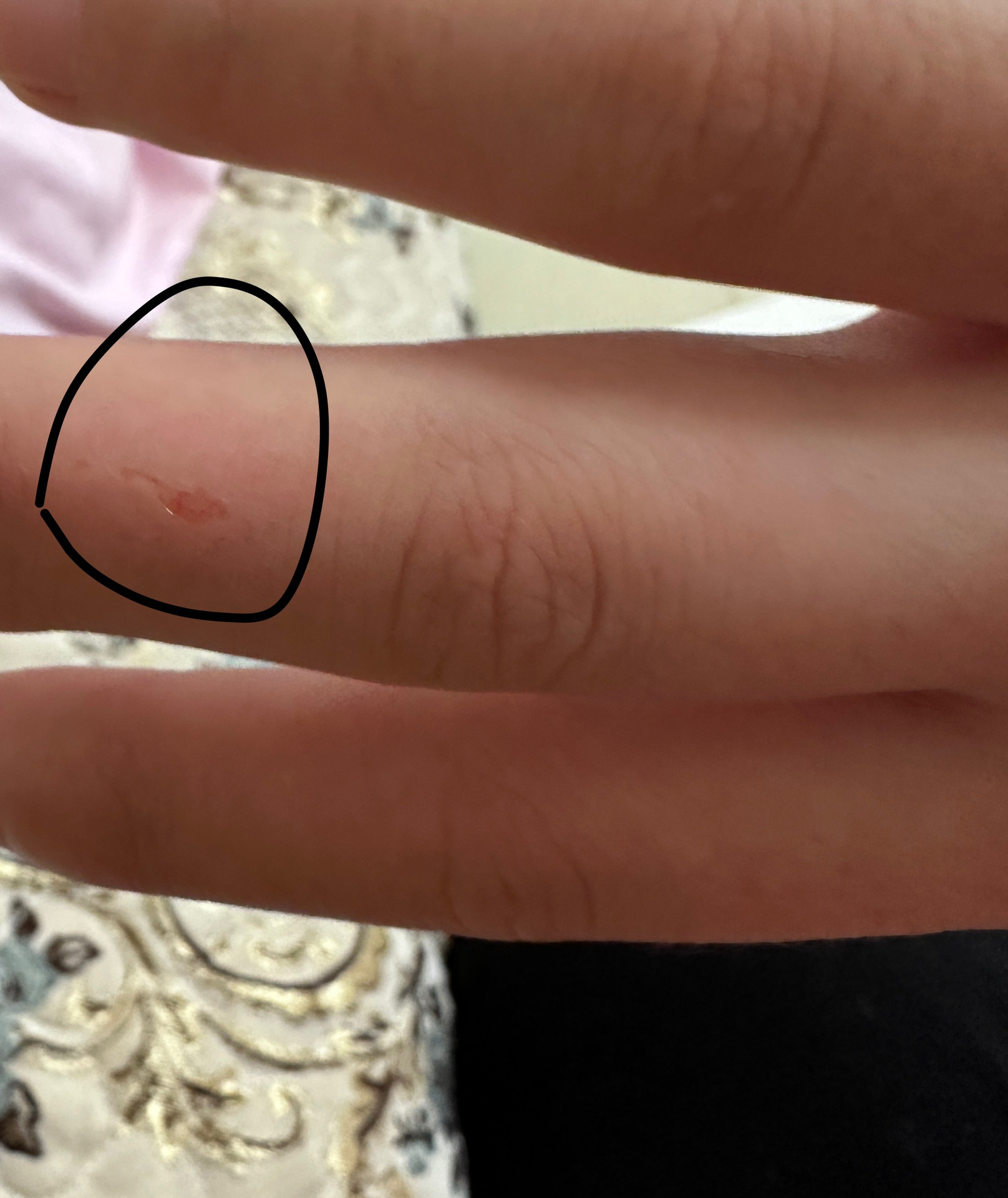 不小心被小狗牙齿划破不打针会有什么反应