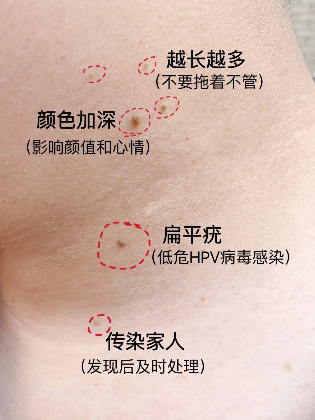 脸上有瘊子怎么去掉