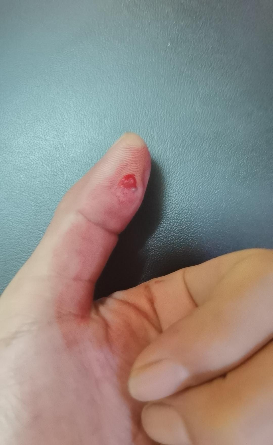 梦见被乌龟咬手指出血