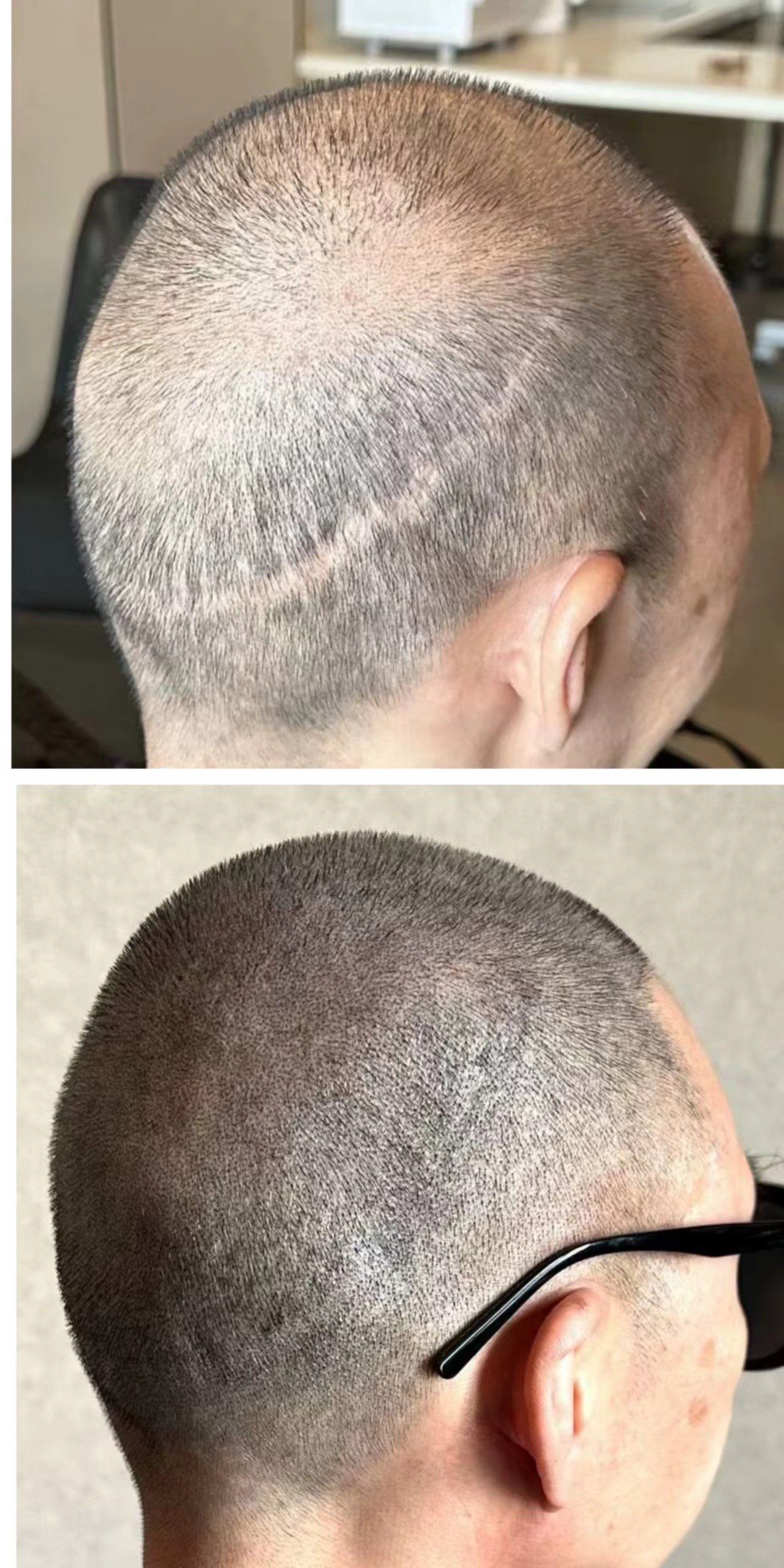 梦见脱发严重什么意思