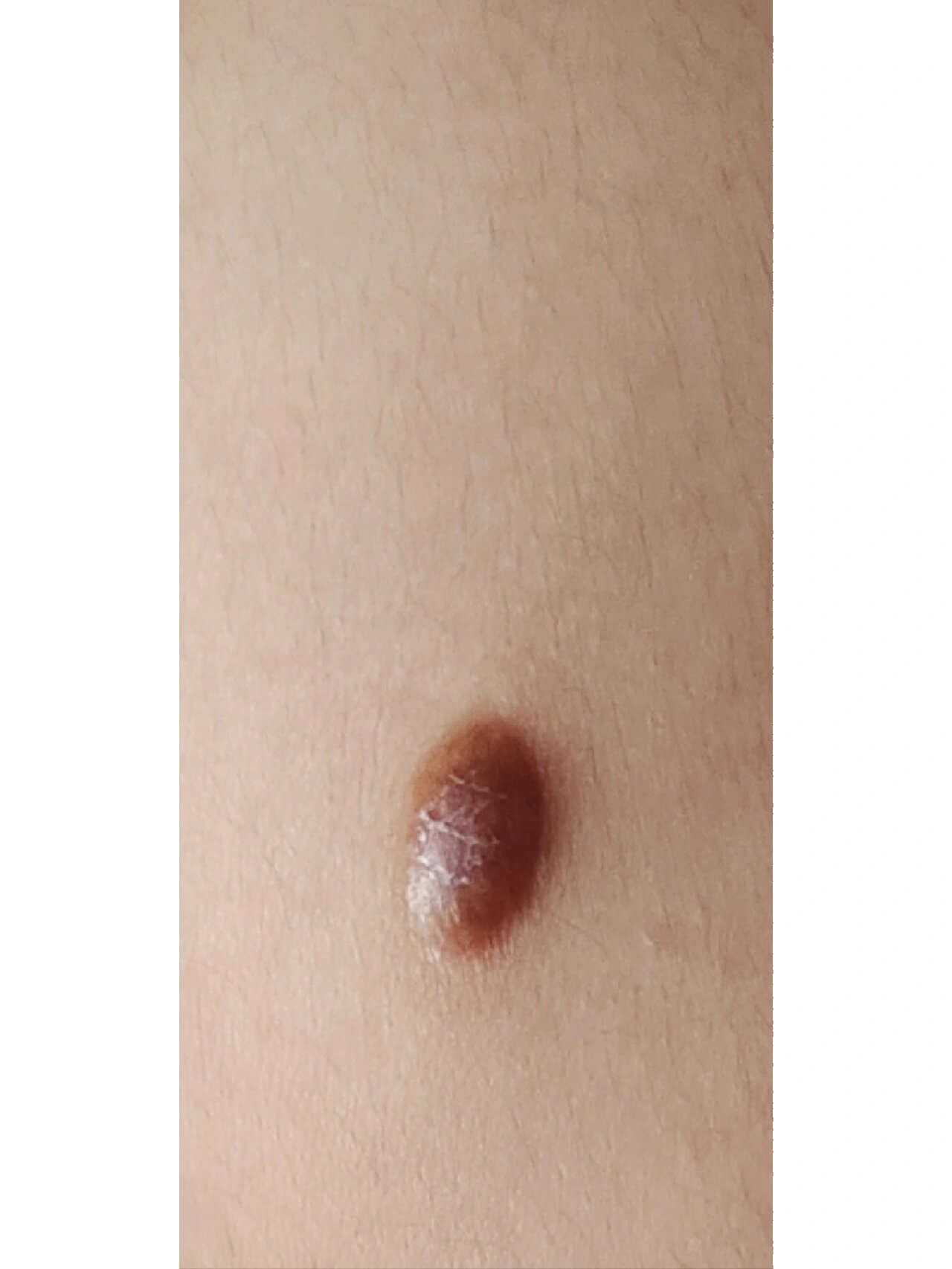 梦见胳膊上长疙瘩然后开了花