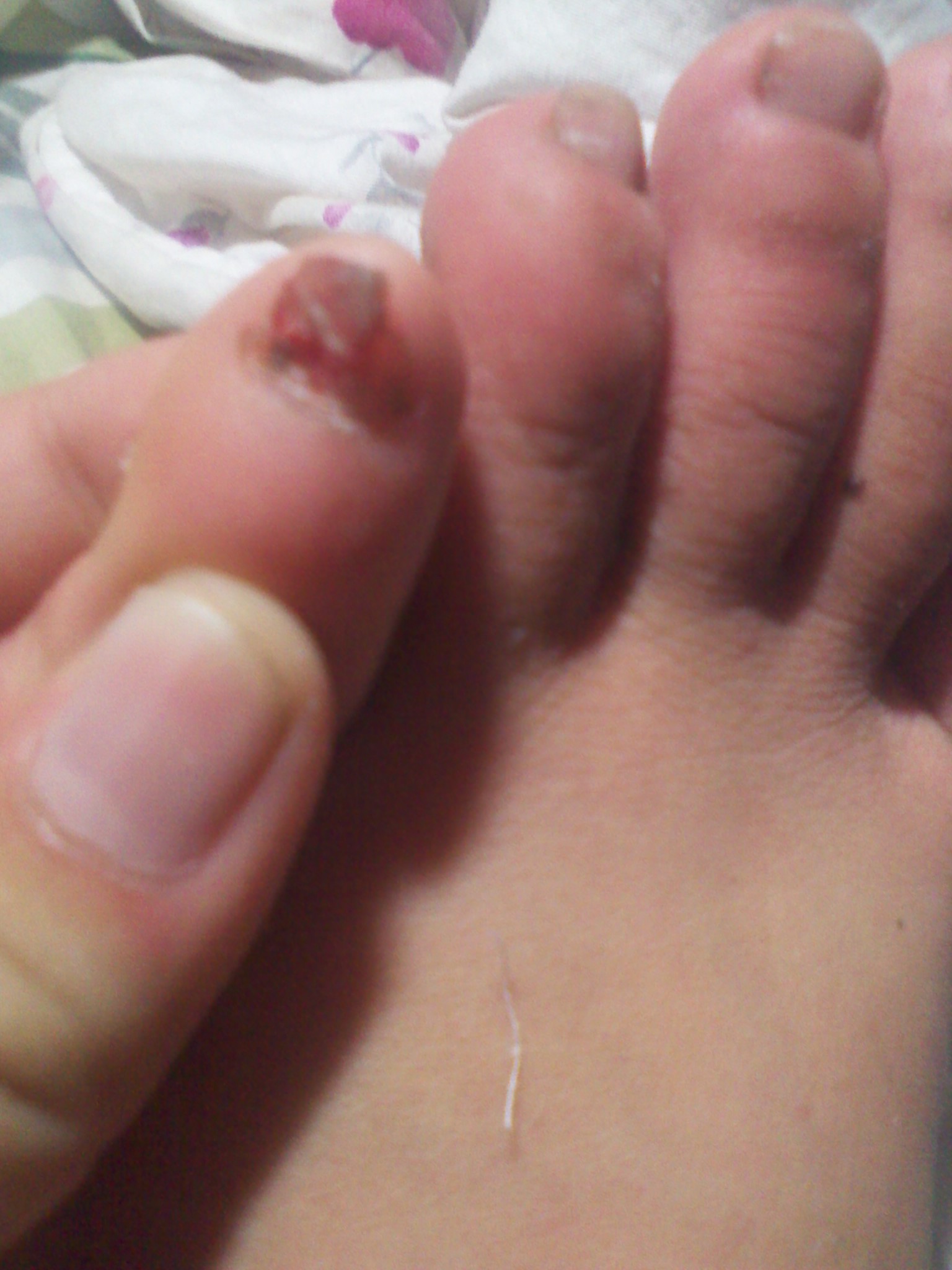 脚指甲盖里面撞出血怎么处理