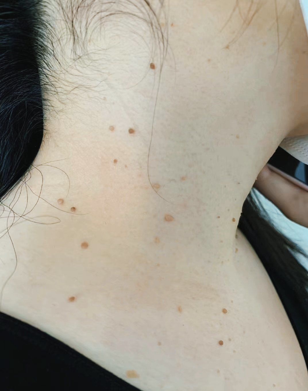 瘊子是什么原因长出来的如何治疗