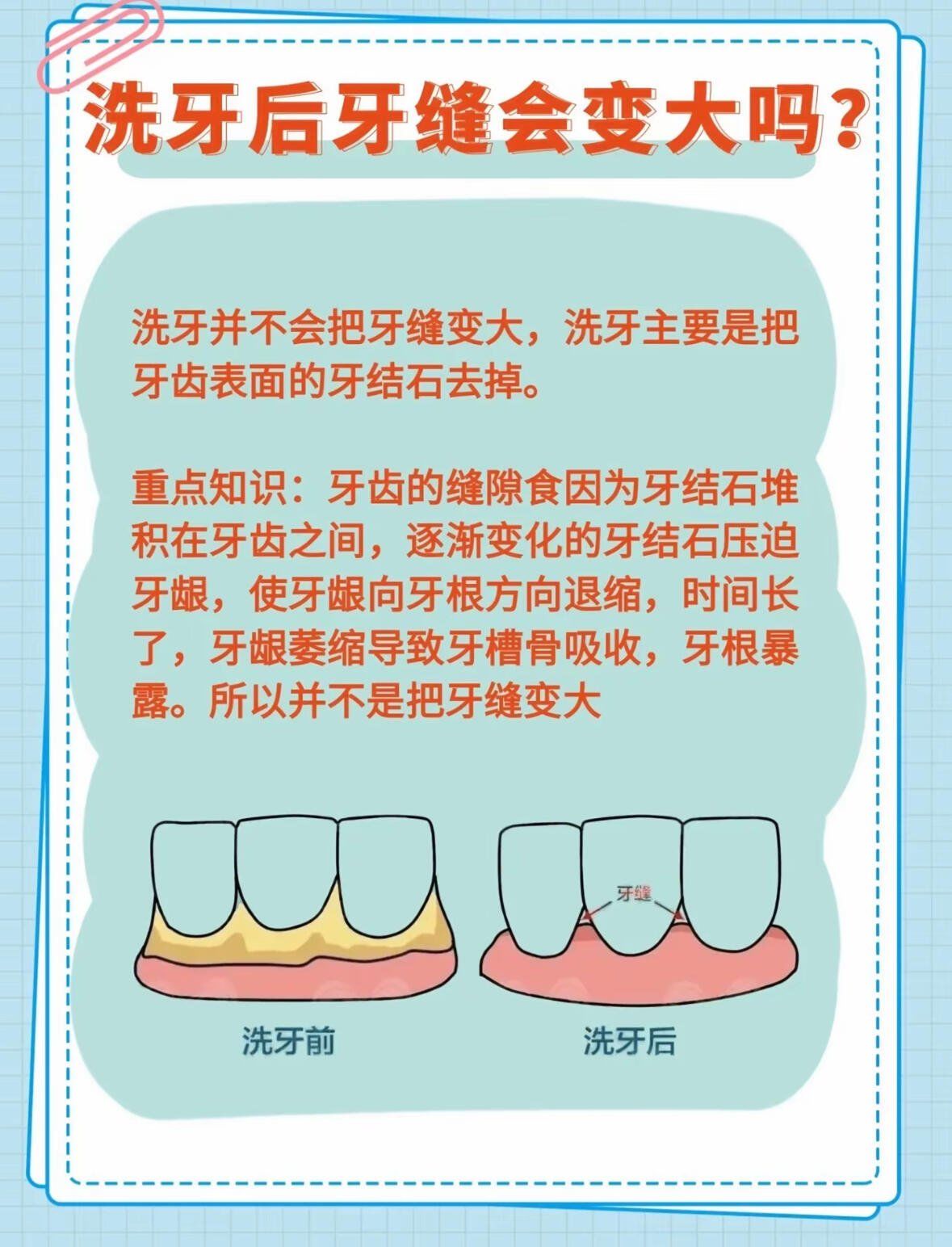 洗牙多少钱一次